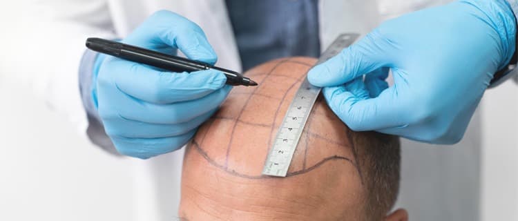 Hair Transplant UK – Your Journey to Fuller, Thicker Hair