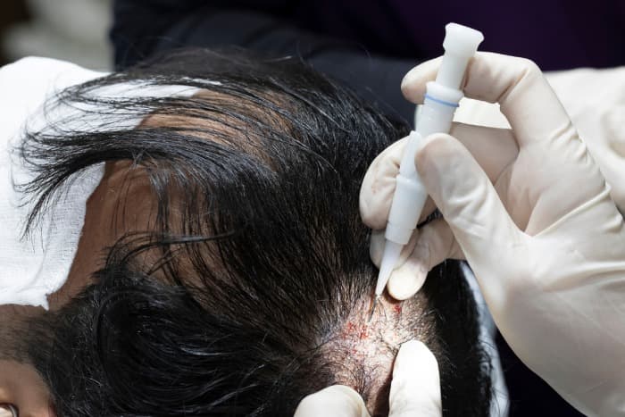 Hair Transplant Istanbul – Trusted Professionals, Natural Results
