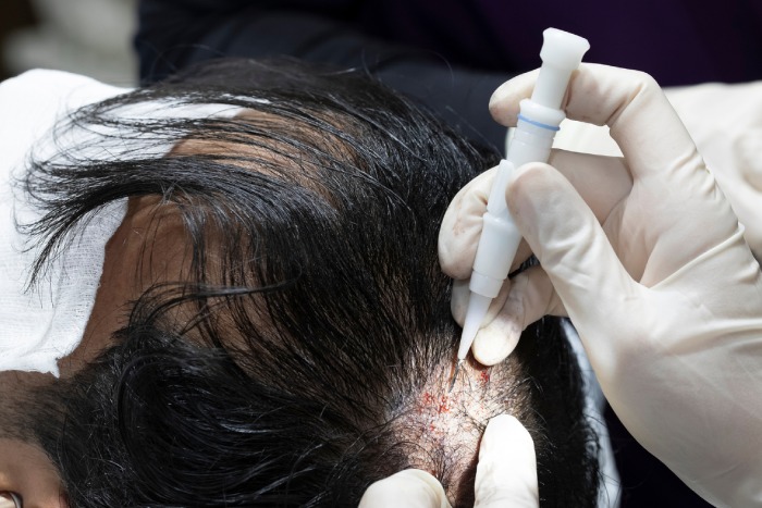 Hair Transplant Istanbul – Trusted Professionals, Natural Results