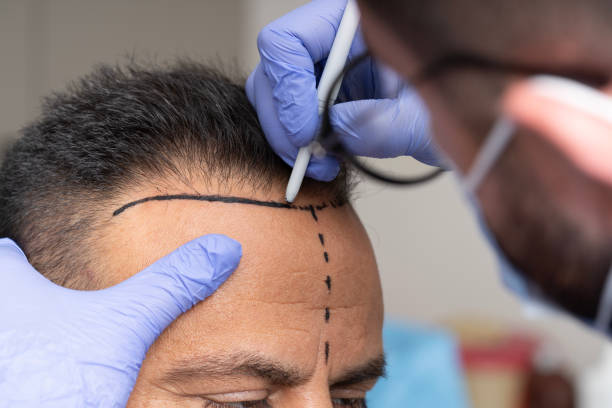 Hair Transplant Turkey Cost vs Quality: Why Patients Travel Abroad