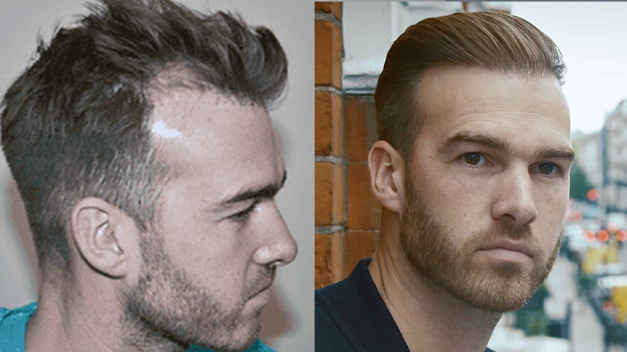 Best Rated Hair Transplant London Clinic for Natural Results